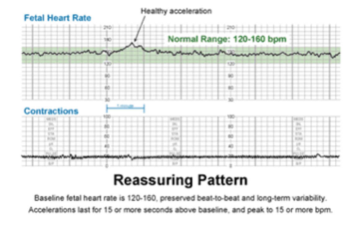 <p>Baseline FHR 120-160 bpm</p><p>Presence of periodic accelerations (2 accelerations w/in 20 minutes) w/ increases of 15 bpm for 15s</p>