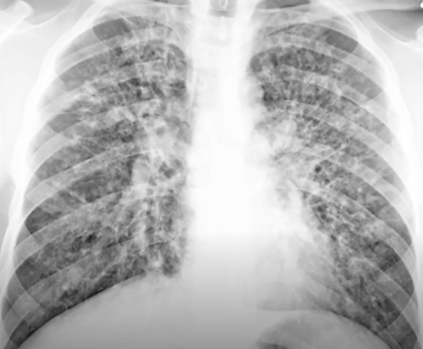<p>variable sized cysts on a background of densely scarred lung tissue; easier to see on CT scan</p>