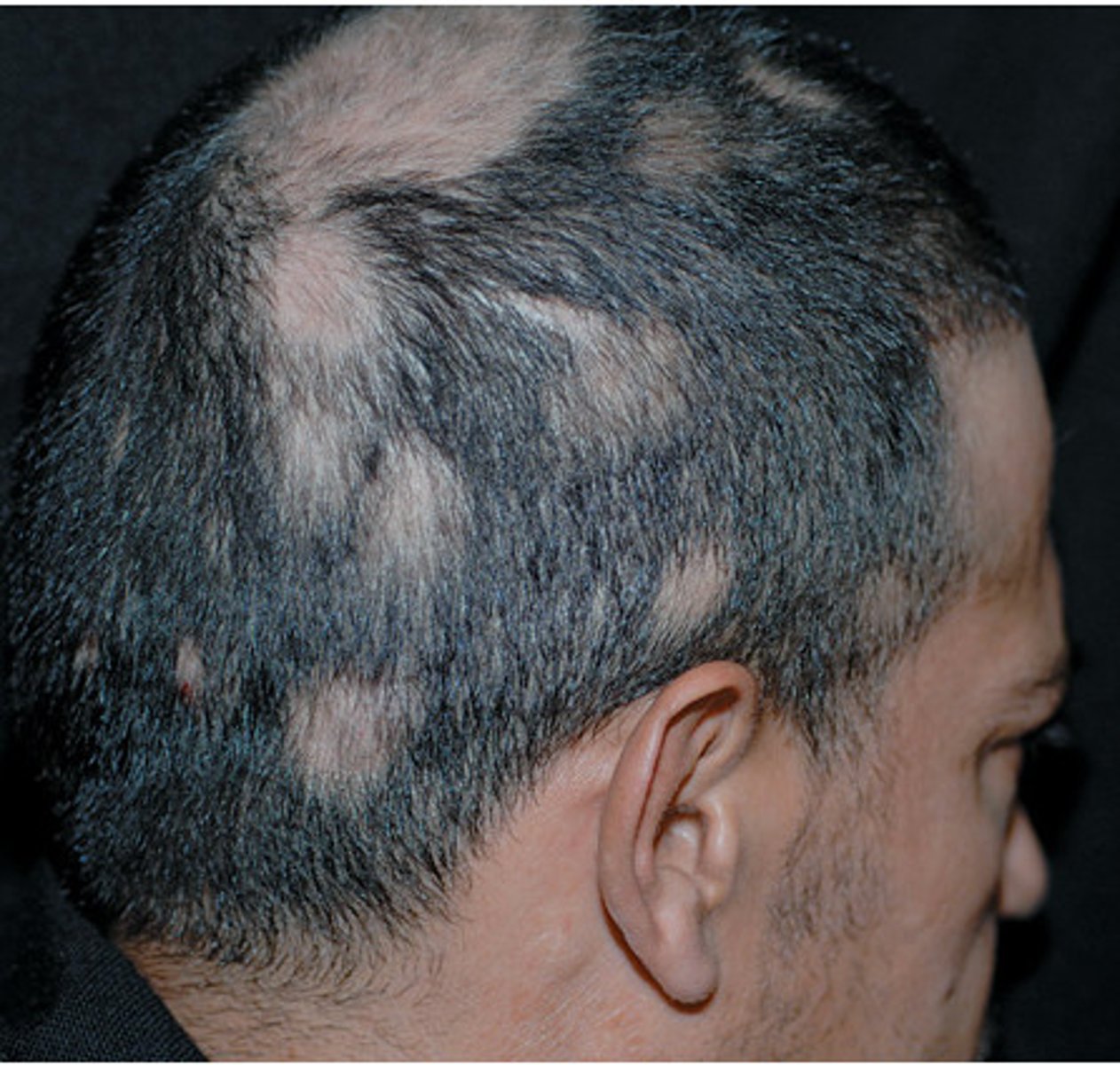 <p>solitary or multiple areas of hair loss</p>