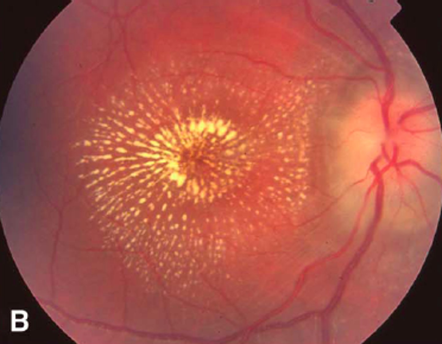 <p>circle of hard exudates around macula → indicates macular edema</p><p>image - bit extreme of an example</p>