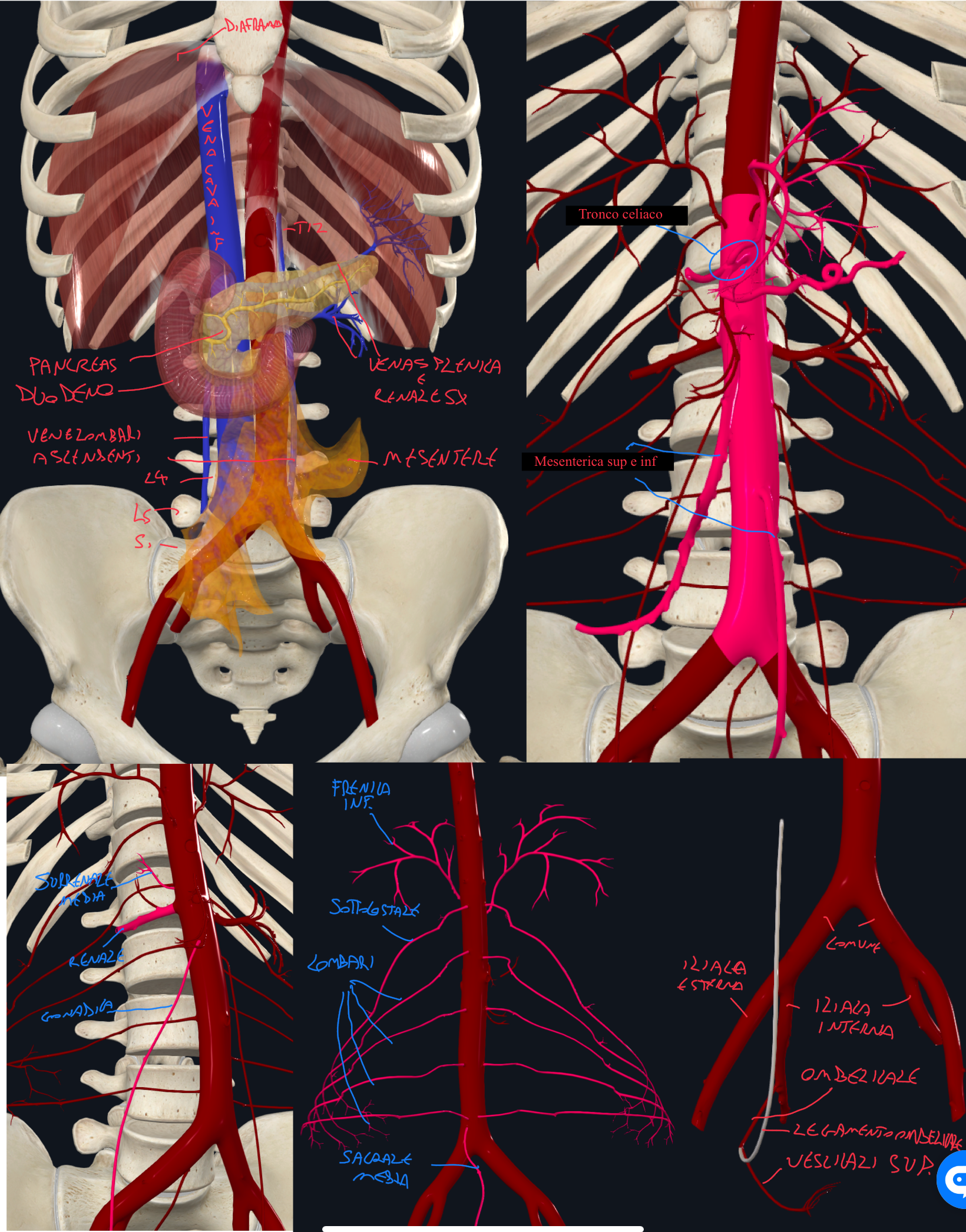 <p>Aorta discendente addominale:</p><ul><li><p>Attraversato il diaframma dall’orifizio aortico, a livello T12, l’aorta discendente toracica diventa addominale e continua fino a L4, dove biforca nelle Arterie Iliache Comuni</p></li><li><p>Esegue un decorso retroperitoneale, anteriore alla colonna</p></li></ul><p>Rapporti Anteriori:</p><ul><li><p>Plessi e gangli paravertebrali del simpatico</p></li><li><p>Corpo del Pancreas</p></li><li><p>Vena Splenica e Renale Sinistra</p></li><li><p>Duodeno → porzione orizzontale, C duodenale</p></li><li><p>Radice del Mesentere</p></li></ul><p>Rapporti Laterali:</p><ul><li><p>A destra:</p><ul><li><p>Vena Cava Inferiore con dietro la Vena Lombare Ascendente Destra</p></li><li><p>Pilastro destro del diaframma</p></li></ul></li><li><p>A sinistra:</p><ul><li><p>Vena Lombare Ascendente Sinistra</p></li><li><p>Pilastro Sinistro del diaframma</p></li></ul></li></ul><p>Rapporti Posteriori:</p><ul><li><p>Corpi vertebrali T12-L4</p></li></ul><p>Rami Dell’Aorta Discendente Addominale:</p><ul><li><p>Dalla faccia anteriore originano i Rami Viscerali Impari:</p><ul><li><p>Tronco Celiaco → che emette la Gastrica Sinistra, Epatica Comune e Splenica</p></li><li><p>Arteria Mesenterica Superiore → origina a livello di L1 e vascolarizza l’intestino dal duodeno distale ai 2/3 del colon trasverso</p></li><li><p>Arteria Mesenterica Inferiore → origina a livello di L3 e vascolarizza l’ultimo 1/3 del colon trasverso fino al retto</p></li></ul></li><li><p>Dalla faccia laterale originano i Rami Viscerali Pari:</p><ul><li><p>Arterie Renali → origine ad angolo retto (<span>questa origine facilita l’ipoperfusione renale, che attiva il sistema renina-angiotensina-aldosterone facendo aumentare la pressione).</span><br><span>La dx è più lunga.</span></p></li><li><p>Arterie Surrenali Medie → mentre le superiori originano dalle freniche superiori e le inferiori dalle renali</p></li><li><p>Arterie Gonadiche → testicolari o ovariche</p></li></ul></li><li><p>I Rami Parietali invece, sono:</p><ul><li><p>Arterie Freniche Inferiori (faccia anteriore)</p></li><li><p>Sottocostali (faccia posteriore)</p></li><li><p>Arterie Lombari (faccia posteriore)</p></li><li><p>Arteria Sacrale Media (unico ramo parietale impari)</p></li></ul></li></ul><ul><li><p>A livello di L5-1 abbiamo le Arterie Iliaca Interna ed Esterna, dalla biforcazione della Iliaca Comune:</p><ul><li><p>La Iliaca Interna per pareti e organi pelvici</p></li><li><p>La iliaca esterna per l’arto inferiore</p></li><li><p>La Arteria Ombelicale è un ramo della iliaca interna, che in vita fetale si connette alla placenta, poi dopo la nascita il suo tratto distale diventa legamento ombelicale laterale, mentre quello prossimale origina le arterie vescicali superiori</p></li></ul></li></ul><p></p>