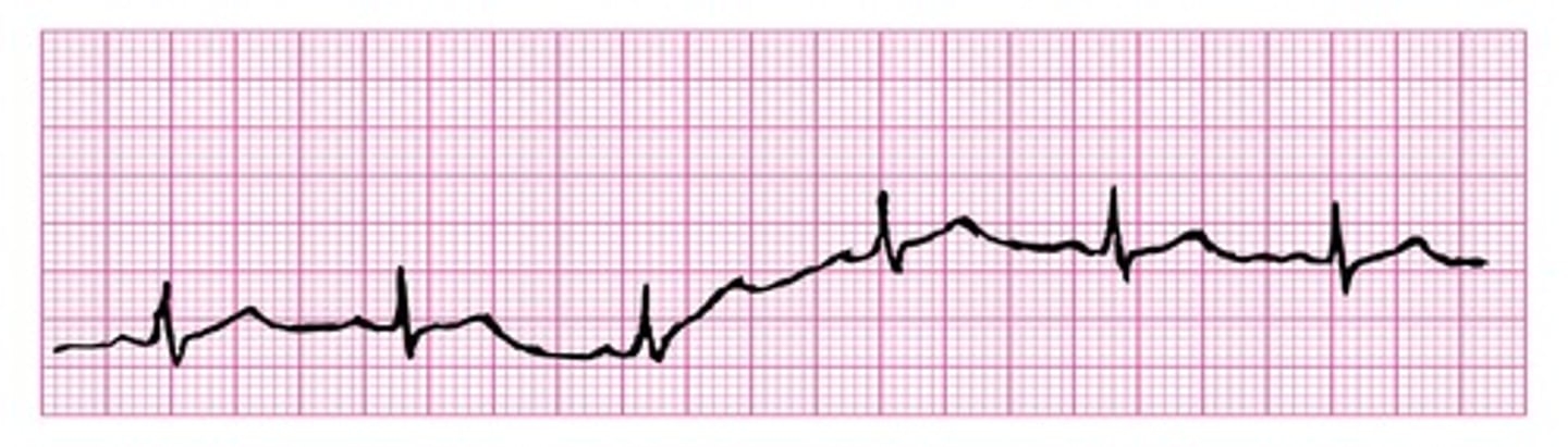 <p>wavelike up-and-down movement throughout the tracing caused by improper electrode placement</p>