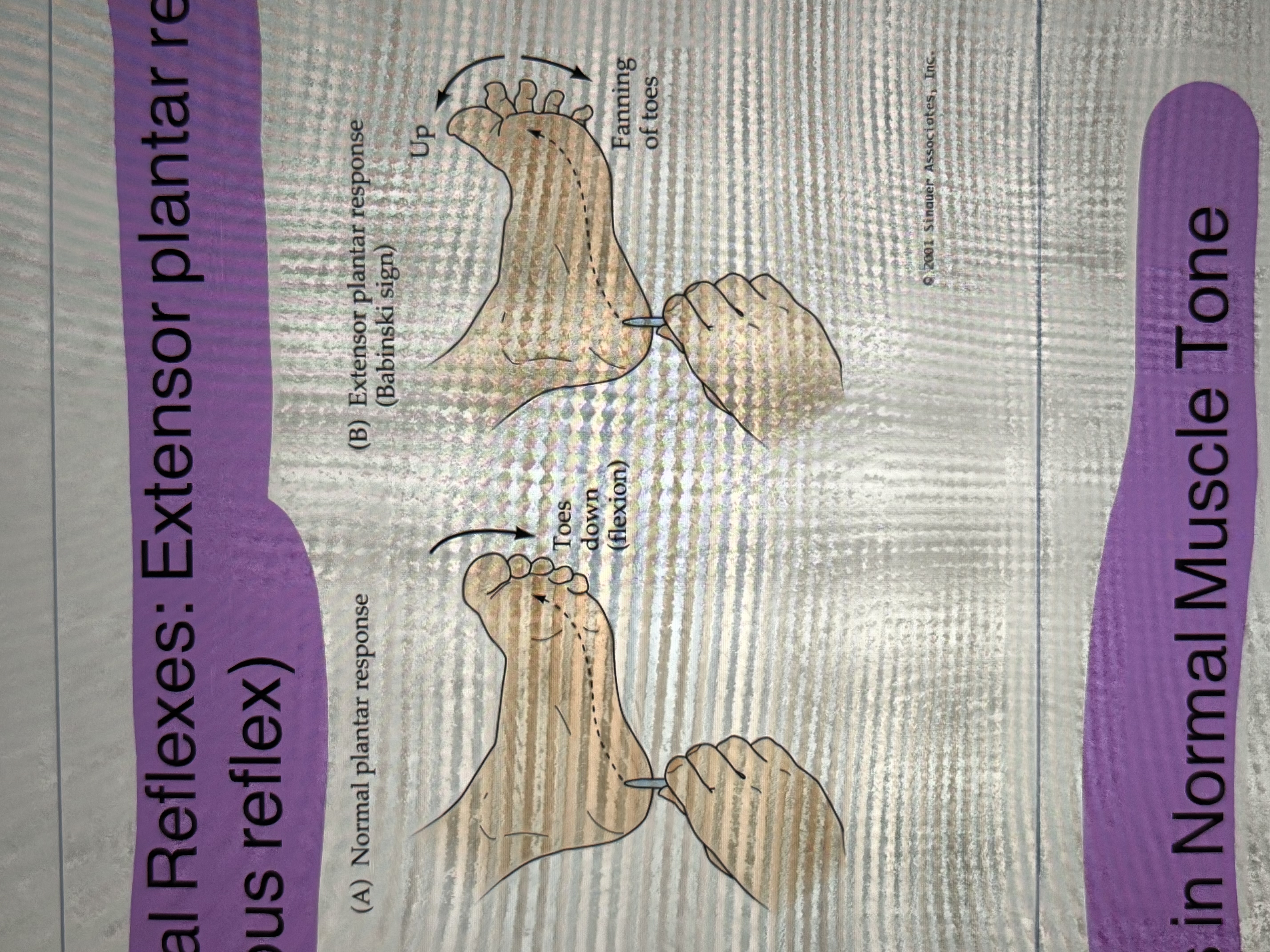 <ul><li><p>extensor plantar response (cutaneous reflex)</p></li></ul><p></p>