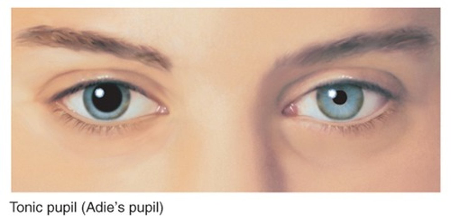<p>Adie's tonic pupil</p>