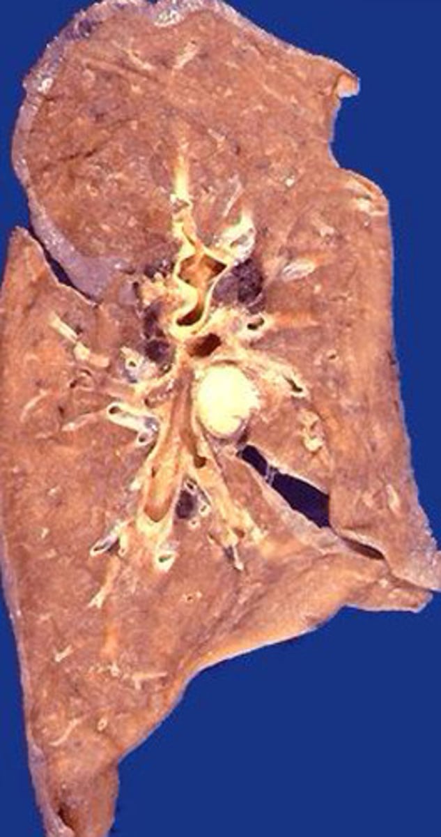 <p>What kind of necrosis is shown?</p>