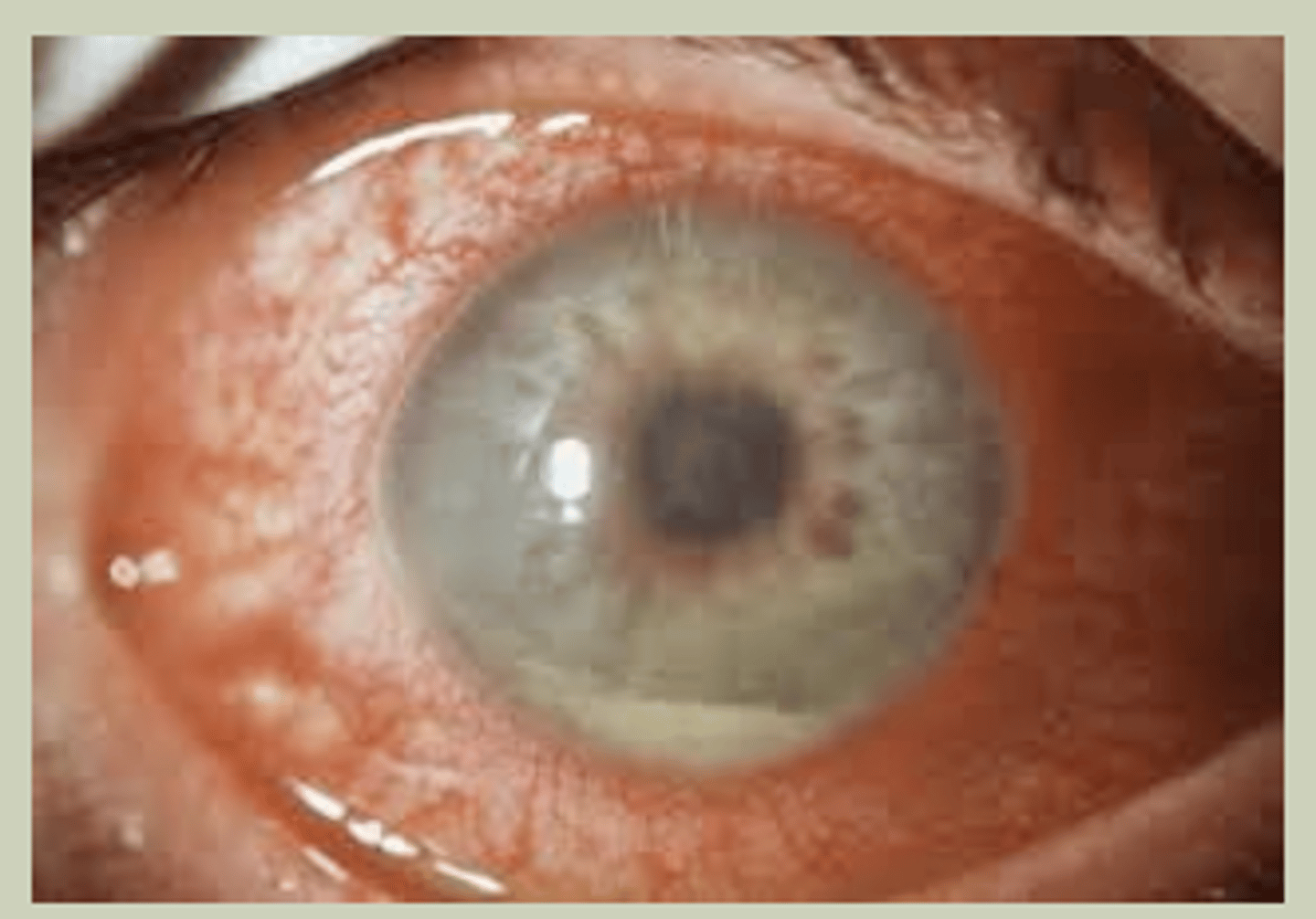 <p>-Unilateral or Bilateral</p><p>-Non-granulomatous vs granulomatous</p><p>-SX: red eye, ocular pain, photophobia</p><p>-Signs: Cell and flare in anterior chamber; need slit lamp to see; may have hypopyon</p><p>-Can be sign of infectious/autoimmune process</p><p>-TX: Topical Steroid q1h, Cycloplegic BID, refer to ECP</p>