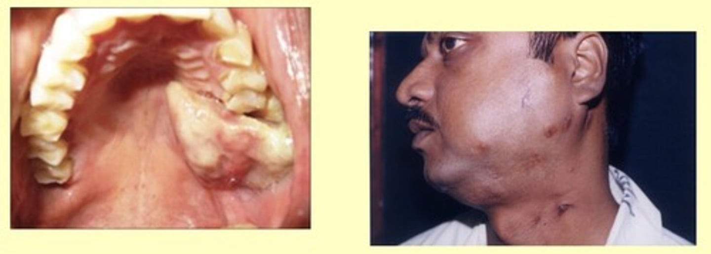 <p>abscess or sinus tract due to actinomyces bacteria</p><p>• bright yellow "sulfur granules" in pus </p>