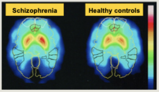 <ul><li><p>Positron Emission Tomography can be used to image neurotransmitter function in living humans</p></li><li><p>PET revealed evidence of increased dopamine synthesis in the striatum of 10 unmedicated schizophrenia patients</p></li></ul><p></p>