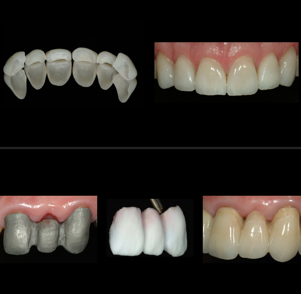<ul><li><p>ceramic veneers </p></li><li><p>metal-ceramic restorations </p></li></ul><p></p>