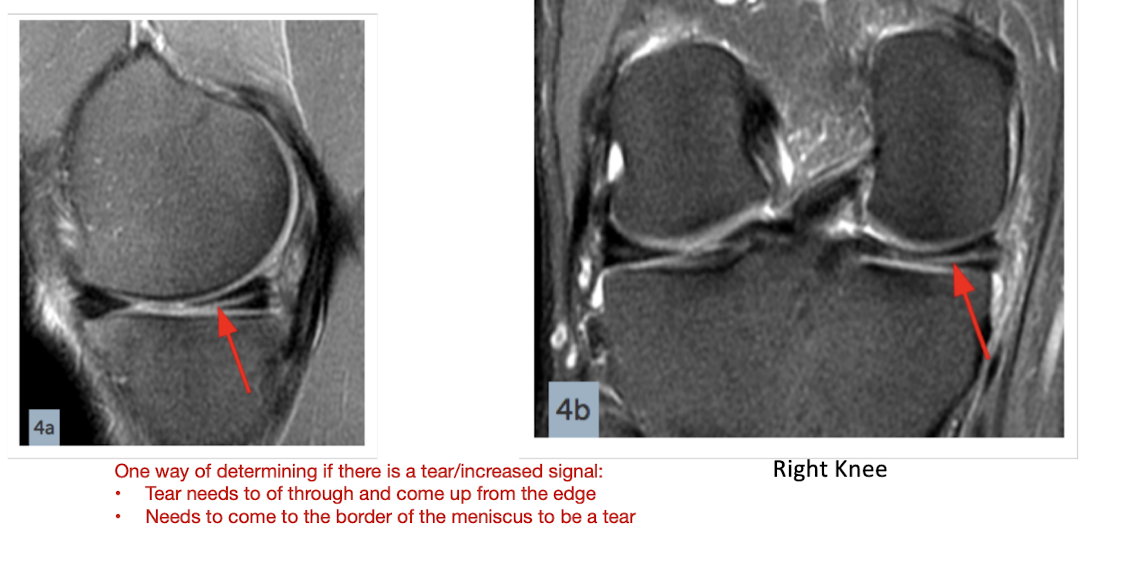 <p>Horizontal Tear:</p><ul><li><p>___ with the Tibial Plateau</p></li><li><p>___ the Meniscus in ___</p></li></ul><p></p>
