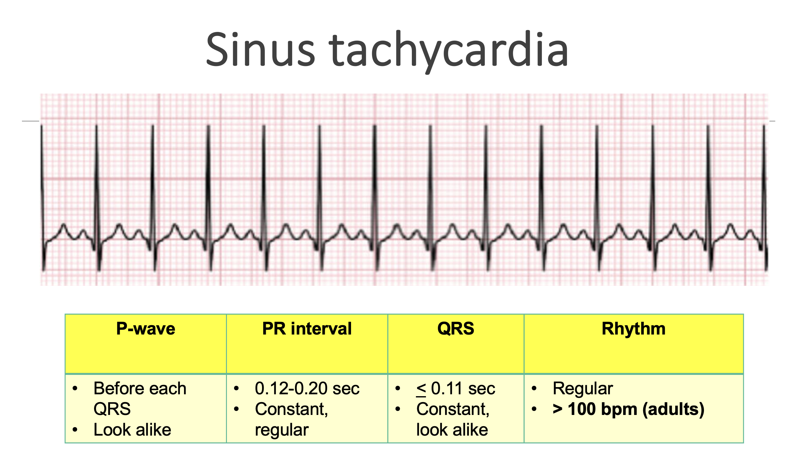 <p>Sinus tachycardia</p>