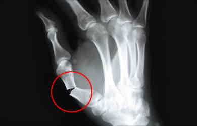 <p>Bone Breaks &amp; pierces through the skin</p>