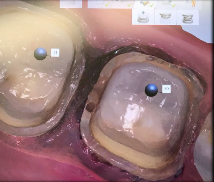 <ul><li><p>even finish line width </p></li><li><p>distinct, smooth and continue </p></li><li><p>>0.6 mm clearance w adjacents </p></li></ul><p></p>