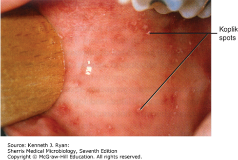 <p>-rhinorrhea, cough</p><p>-Koplik's Spots (<strong>bright red lesions with central dot on buccal mucosa</strong>)</p><p></p><p>after prodromal^ phase → </p><p>Rash on face which spreads to lower extremities (palms and soles too)</p><p></p><p>complication: encephalitis</p>