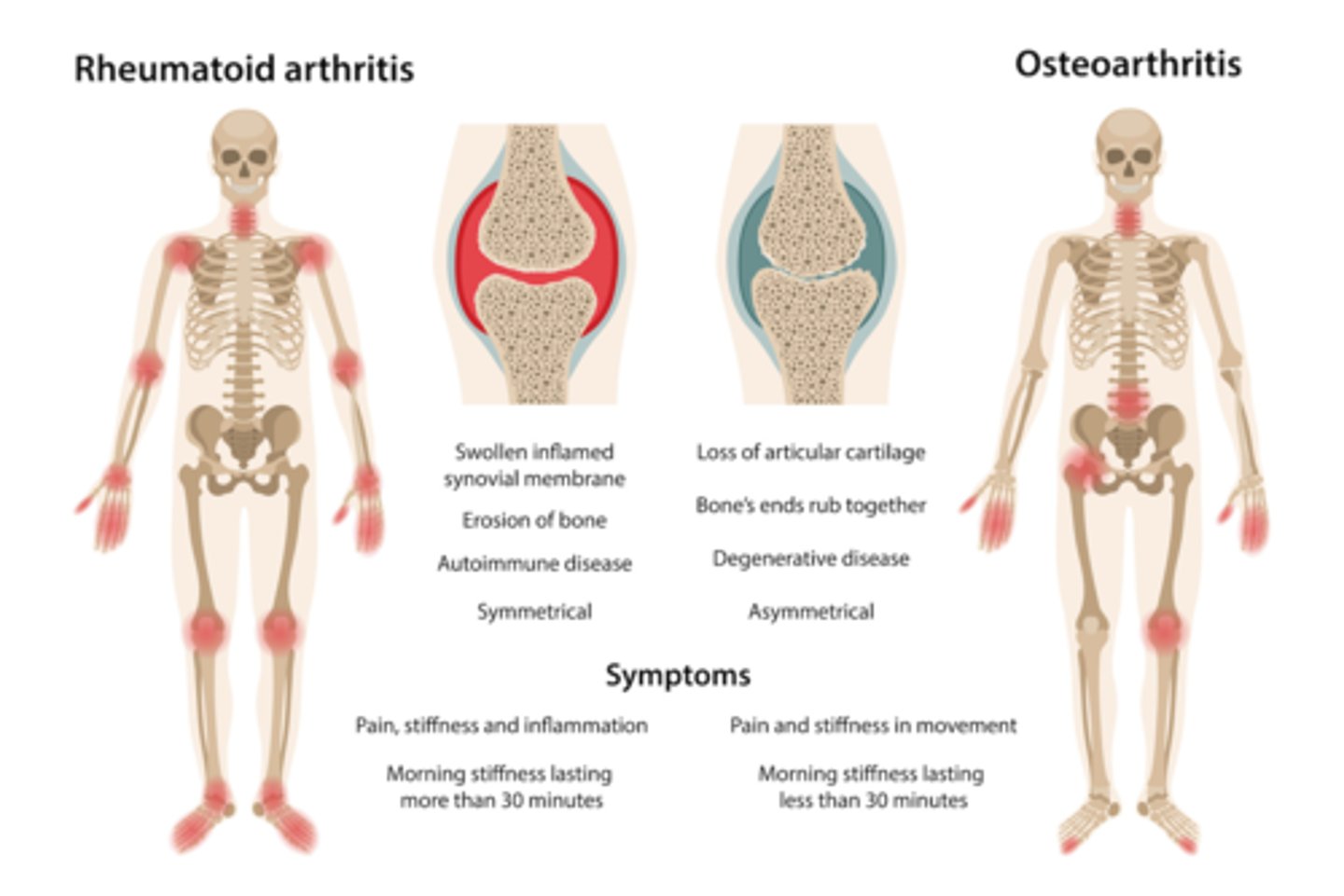<p>excessive production of synovial fluid, enlargement of the synovium, and thickening of the joint capsule</p><p>this weakens the joint capsule and distends tendons and ligaments.</p><p>As the inflammatory process continues, the diseased synovial membrane forms a pannus that actively invades and destroys cartilage, bone, tendon, and ligament.</p><p>Scar tissue can form between the bone ends and cause the joint to become permanently rigid and immovable.</p>
