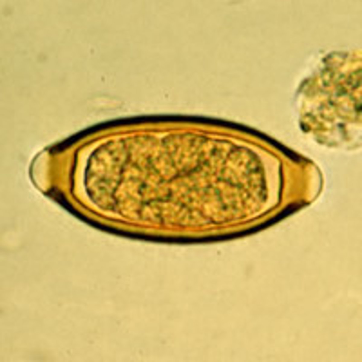 <p>Trichuriasis</p><p>Helminth (nematoda, roundworm)</p><p>aka <strong><em>whipworm</em></strong></p><p>fecal-oral route</p><p>fecal smear</p>