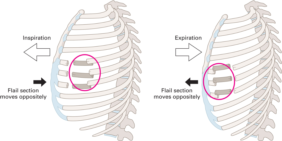<ul><li><p><span><span>Movement of flail segment is opposite to movement of the remainder of the chest cavities.</span></span></p></li></ul><p></p>