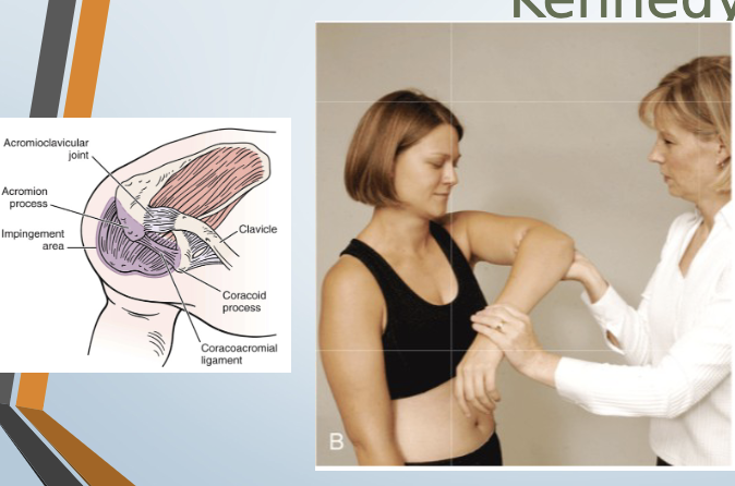 <p>Hawkins-Kennedy Test</p>