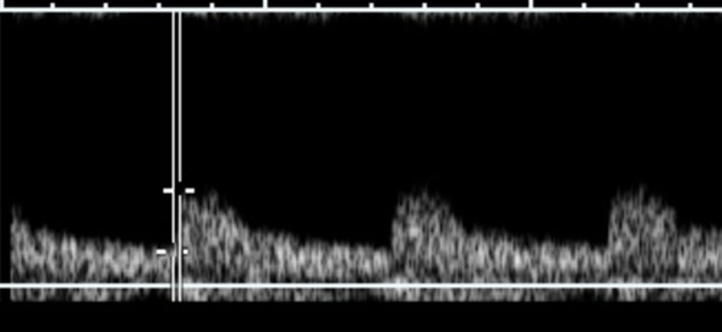 <p>Change in velocity divided by acceleration time</p>