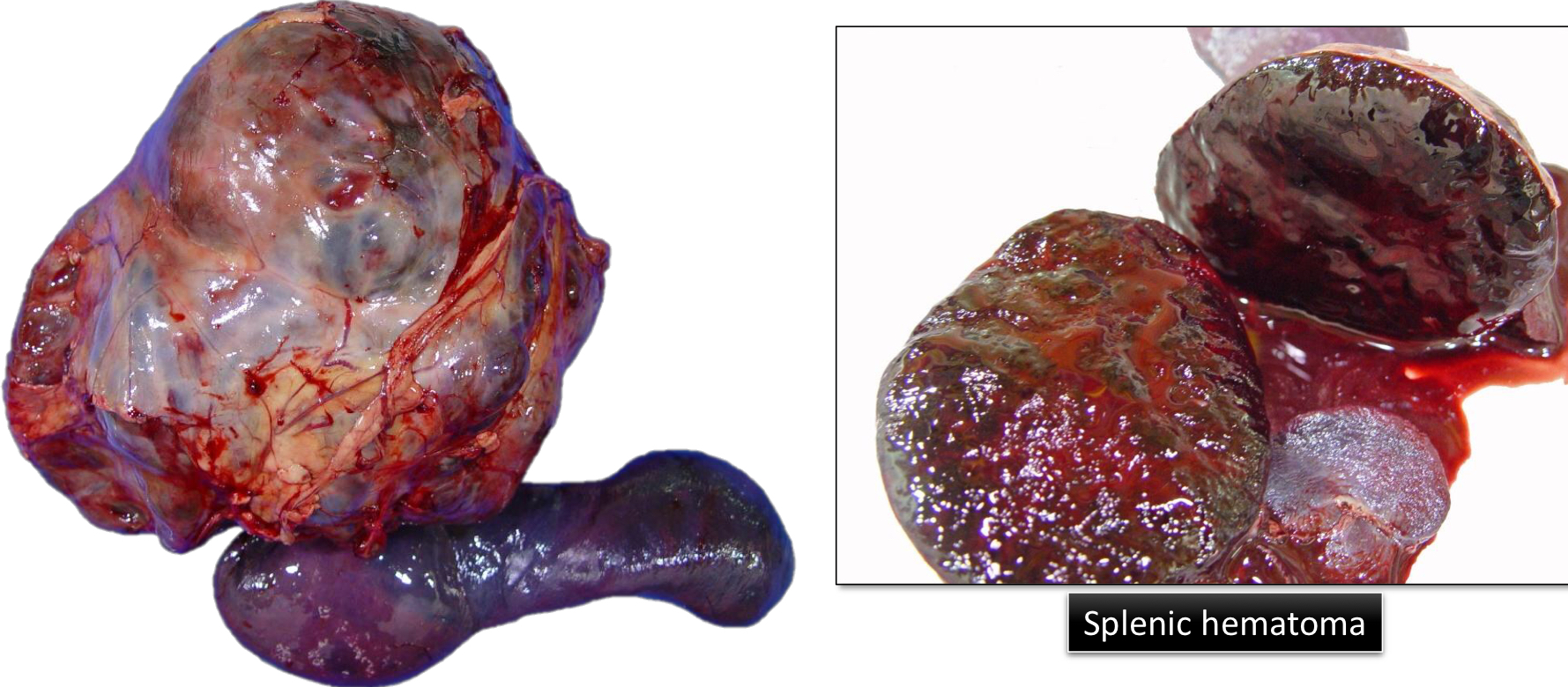 <ul><li><p>Hemorrhage enclosed within a tissue</p></li><li><p>Extravascular 3-dimensional blood clot</p></li></ul><p></p>