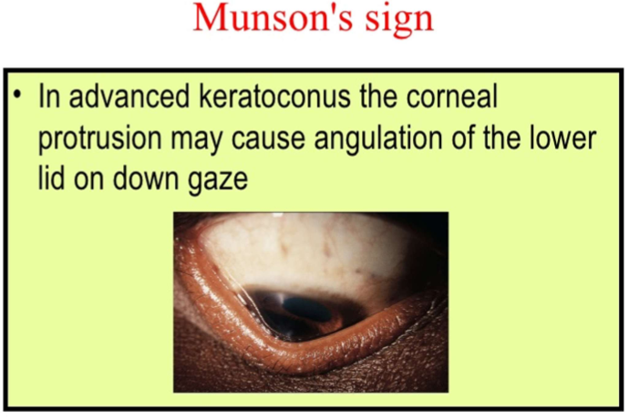 <p>You can see Keratoconus corneal protrusion when pt. looks at down gaze</p>