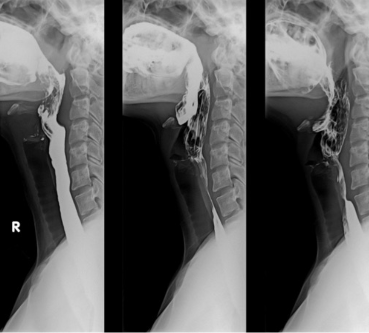<p>What imaging is used to assess for <strong>esophageal stricture or dysphagia (difficulty swallowing), may include fluoroscopy?</strong></p>
