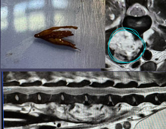 <p>Infection/empyema of the spine</p>