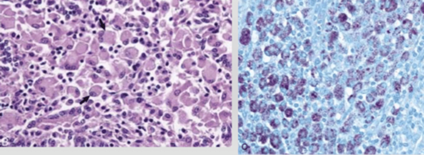 <p>acid fast bacteria; Mycobacterium and Nocardia</p><p>3 multiple choice options</p>