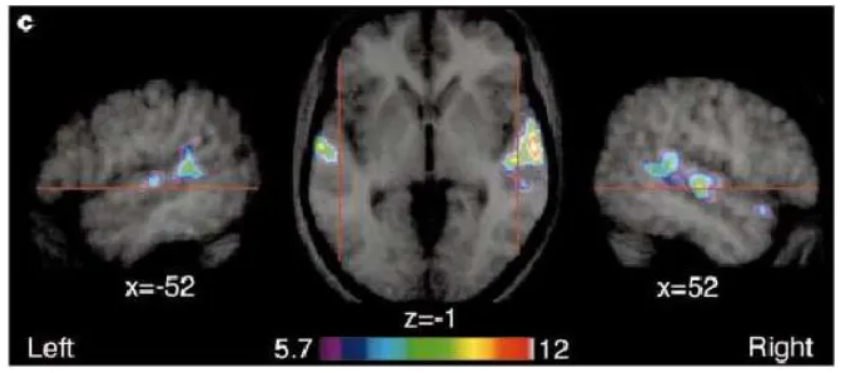 <p>Specific regions in the superior temporal sulcus and gyrus (STS/STG) of the brain that show a stronger response to human voices and vocal sounds compared to other environmental noises, playing a crucial role in voice perception, recognition, and processing vocal cues like identity, emotion, and gender, with distinct subregions involved in different aspects of voice analysis, particularly in the right hemisphere.</p><ul><li><p>Bilateral but often larger on the right</p></li><li><p>Along the upper banks of the superior temporal gyri (i.e. just above the ears).</p></li><li><p>Very robust</p></li></ul><p></p>