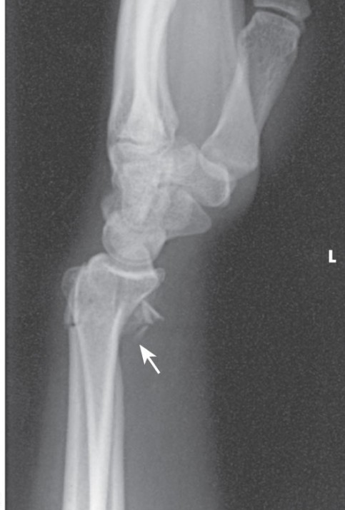 <p>Which fracture is this?</p>
