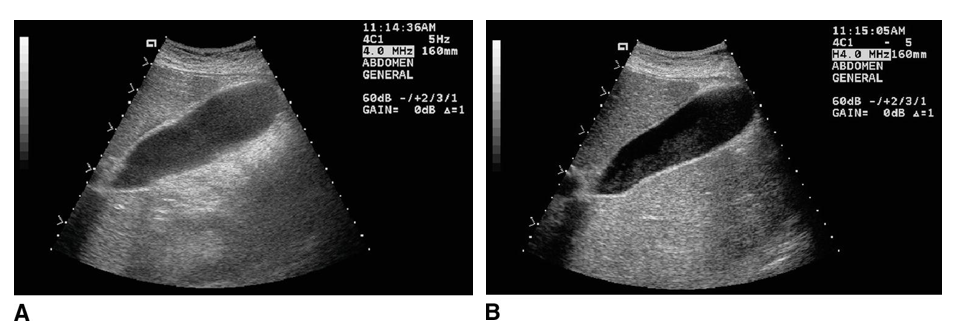 <ul><li><p>Harmonics are additional frequencies, other than the transmitted frequency sent into the body, that are generated by differing human body tissues.</p><ul><li><p>These are collected by the transducer and used to create a crisper, higher-resolution image.</p></li></ul></li></ul><p></p>