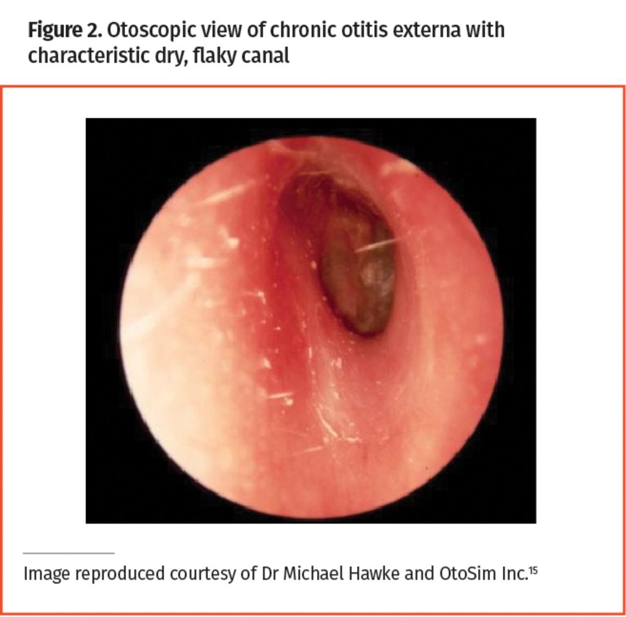 <p>Otitis externa pathology + investigation </p>