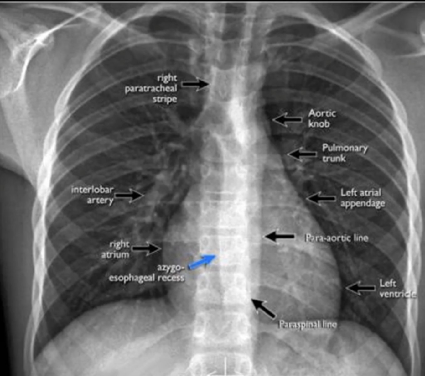 <p>(evaluating AP CXR) cardiac silhouette</p>
