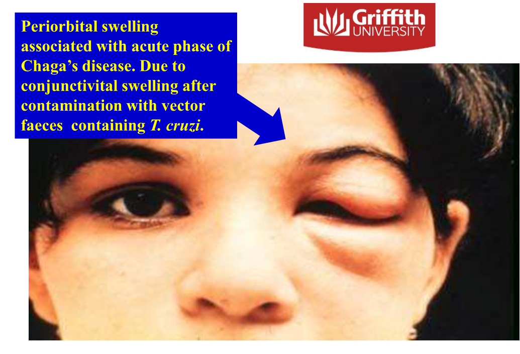 Acute phase = 2 months after infection, mild or absent symptoms, <50% of people - first visible signs are skin lesions, purplish swelling of lids of one eyes (periorbital swell) 

Fever, lymph swelling, muscle pain, dyspnoea 

\
Chronic - parasites hidden in heart, might be associated w cardiac disorders or digestive, neurological etc. 

\
Thought that parasite persistenc and chronic inflammation leads to pathogenesis 