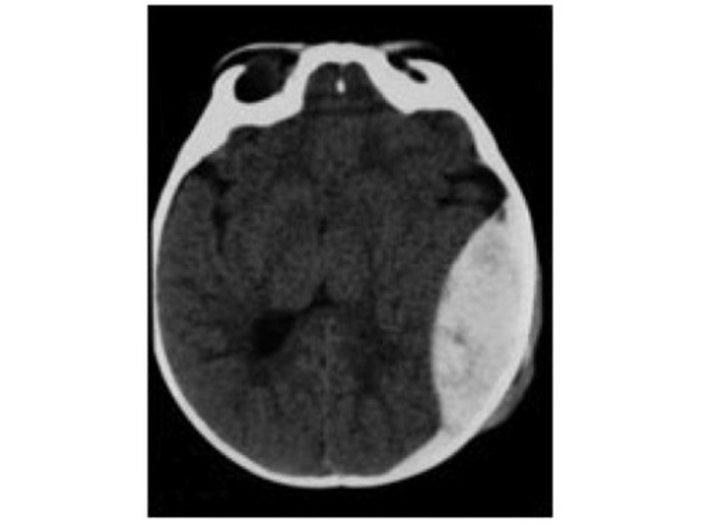 <p>a mass of blood that forms between the skull and the dura mater as a result of the brain colliding against the skull, such as from a head injury or a fall</p>