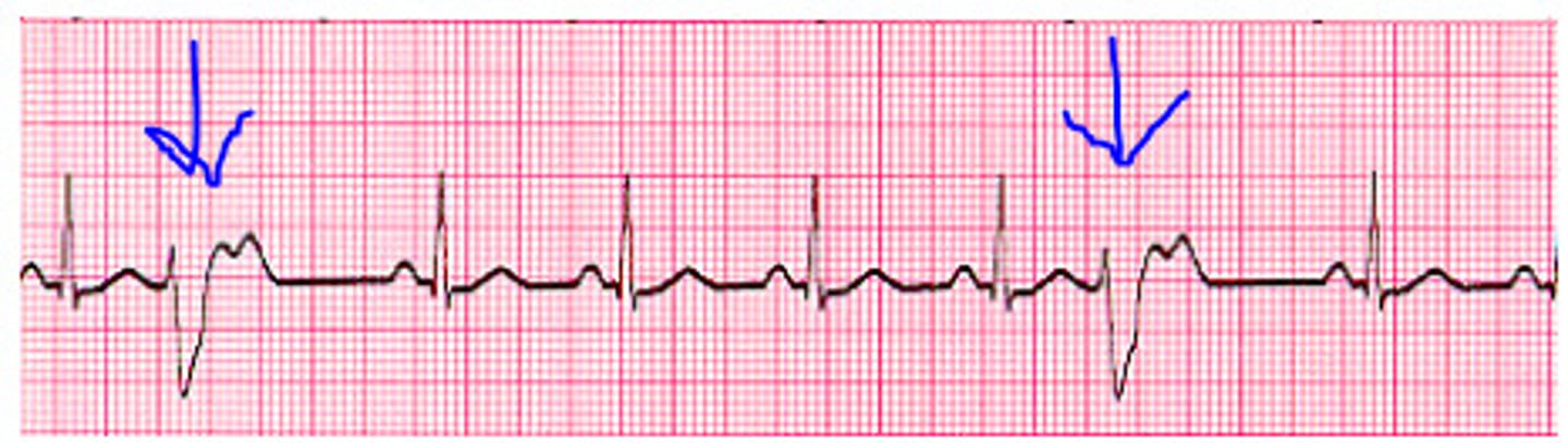 <p>A common cardiac arrhythmia that results in the feeling of skipped or extra beats caused by impulses originating outside the SA node</p>