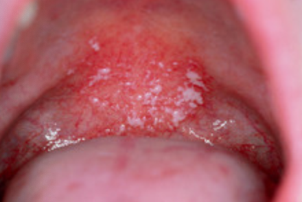 <p>1h.Which management step is essential after inhaler use?</p>