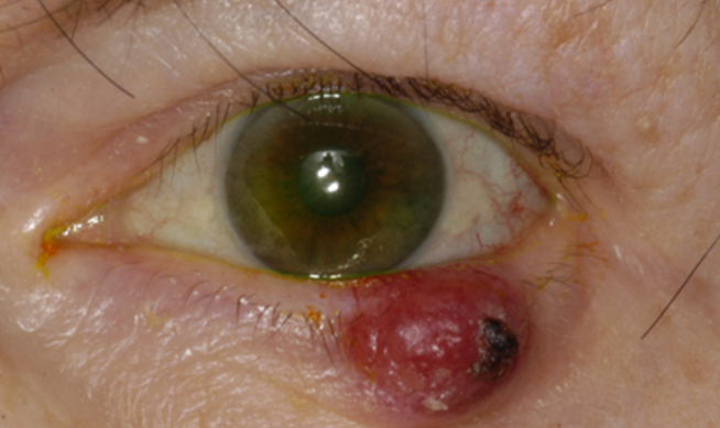 merkell cell carcinoma