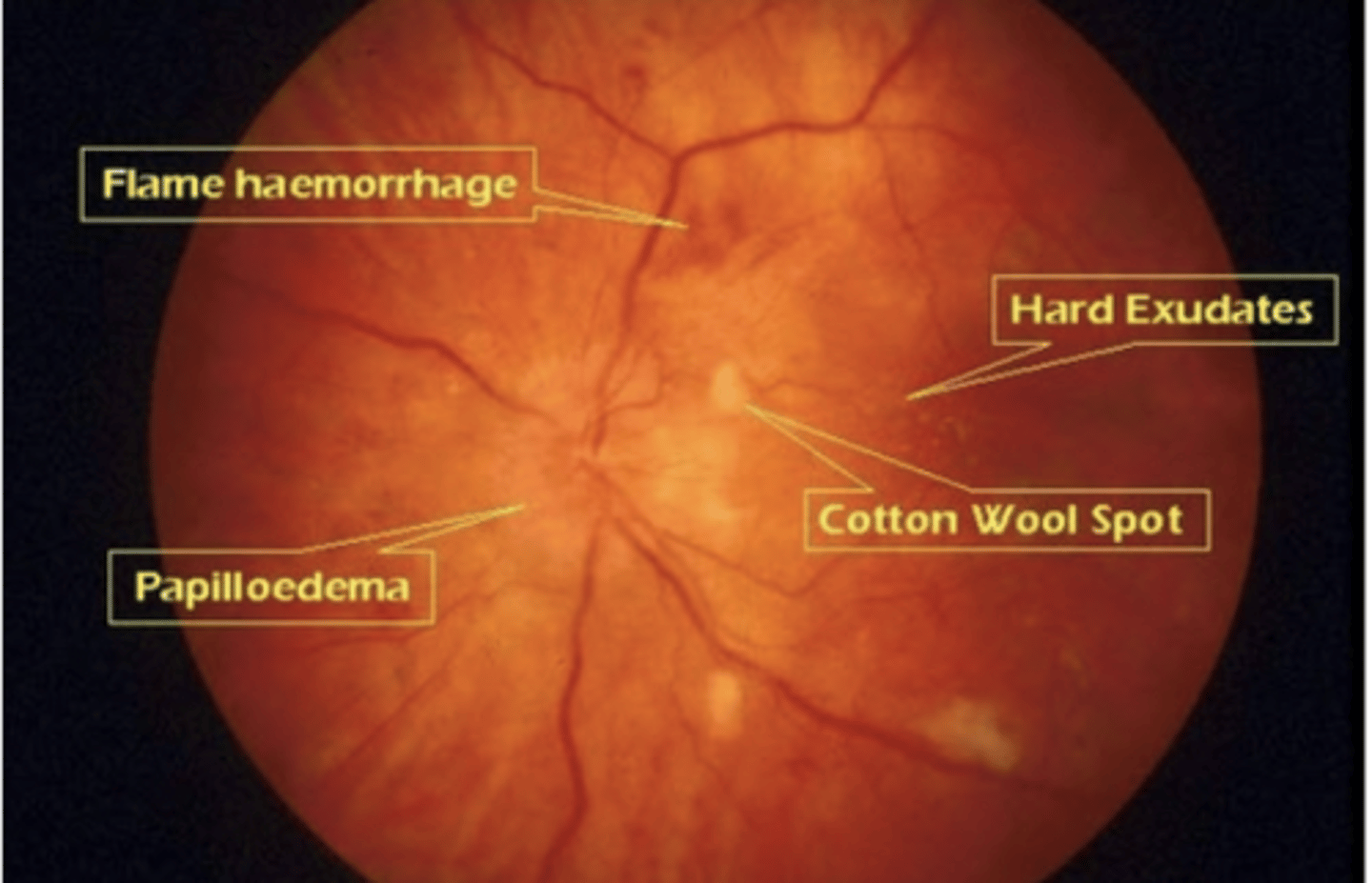 <p><u>Risk factors</u>: HTN &amp; severe HTN, pheochromocytoma, preeclampsia</p><p><u>S&amp;S</u>: <strong><mark data-color="#eaff00" style="background-color: #eaff00; color: inherit">AV nicking, flame hemorrhage, copper/silver wire, papilledema, cotton wool spots, hard exudates, opaque arterial wall</mark></strong></p><p><u>Complications</u>: Blindness</p><p><u>Tx</u>: severe = emergent cardiology &amp; ophthalmology consults, chronic = control HTN, annual eye exam</p>