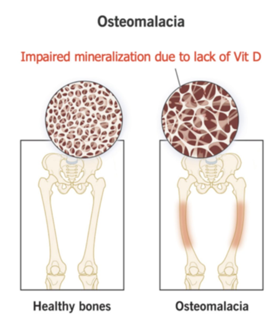 <p>Osteomalacia</p>
