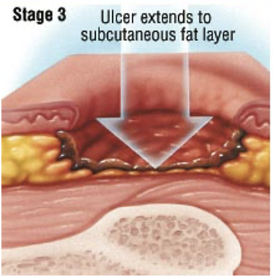 <ul><li><p>Damage to epidermis and dermis ± subcutaneous fat</p></li><li><p>Pain, bleeding</p></li><li><p>May be insensate (lacking physical sensation)</p></li></ul>