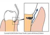 <p><span><strong> You will feel the tip move out and around the raised bump and return back to the tooth surface.</strong></span></p><p><span><strong> “Skating over a speed bump in a parking lot”</strong></span></p>