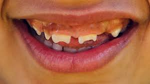 <p>congenital syphillis</p><p>inner notch</p><p>sides of teeth→tapered towards biting edges</p><p>wide spaces inbetween</p><p>m/c→upper central incisors</p>