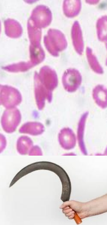 <p>RBCs have an abnormal crescent shape making them sticky and rigid</p><p>Get trapped in small vessels and block blood from reaching different parts of the body- can cause pain and tissue damage.</p><p><strong>Autosomal recessive condition- can be carrier</strong></p>