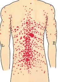 <p>PP: post group A strep pharyngitis infection→abrupt eruption</p><p>E: group A strep pharyngitis</p><p>CM:<br>numerous salmon pink papules+fine scale<br>“drop-like”</p><p>TX:<br><u>topical:</u><br><strong>1st line→topical steroids</strong><br>topical calcipotriene<br>anthralin+coal tar<br>narrow band UV x 3x/week</p><p><u>systemic:</u><br>methotrexate<br>acute→cyclosporine+taper off<br>PO acitretin<br>apremilast</p><p><u>Biologics:</u><br><strong>TNF alpha inhibitors:</strong><br>-entanercept<br>-adalimumab</p><p><strong>interleukin 12+23 inhibitor:</strong><br>-ustekinumab</p><p><strong>interleukin 17 inhibitors:</strong><br>-ixekizumab<br>-secukinumab</p><p><strong>interleukin 23 inhibitor:</strong><br>-guselkumab<br>-risankizumab<br>-tildrakizumab</p>