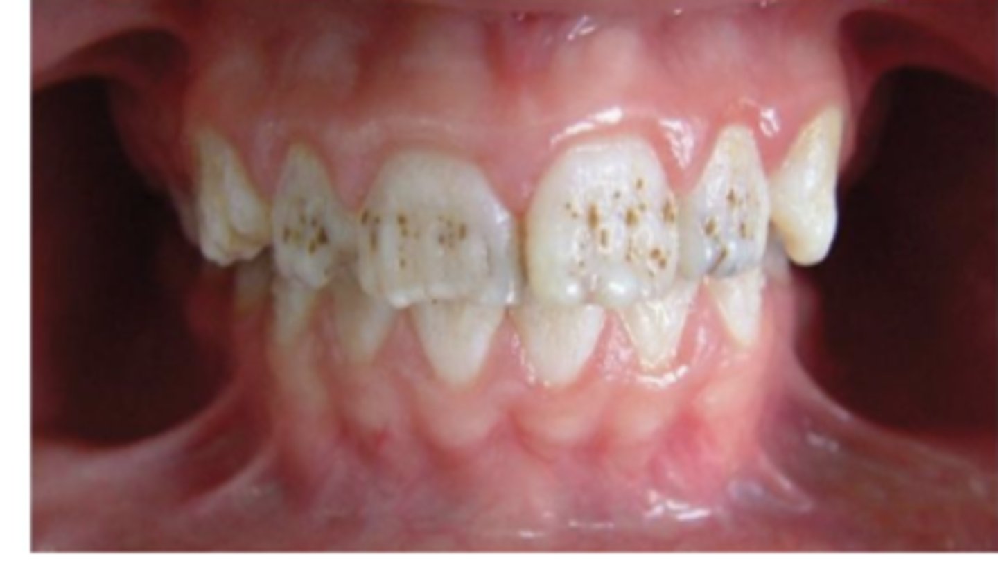 <p>your patient presents with teeth as shown in the picture. the patient has no previous history of caries. what condition does this patient have?</p>