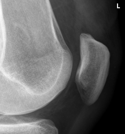 <p>same as LAT KNEE, <strong>EXCEPT</strong></p><ul><li><p>BTP is not assessed </p></li></ul><p></p>