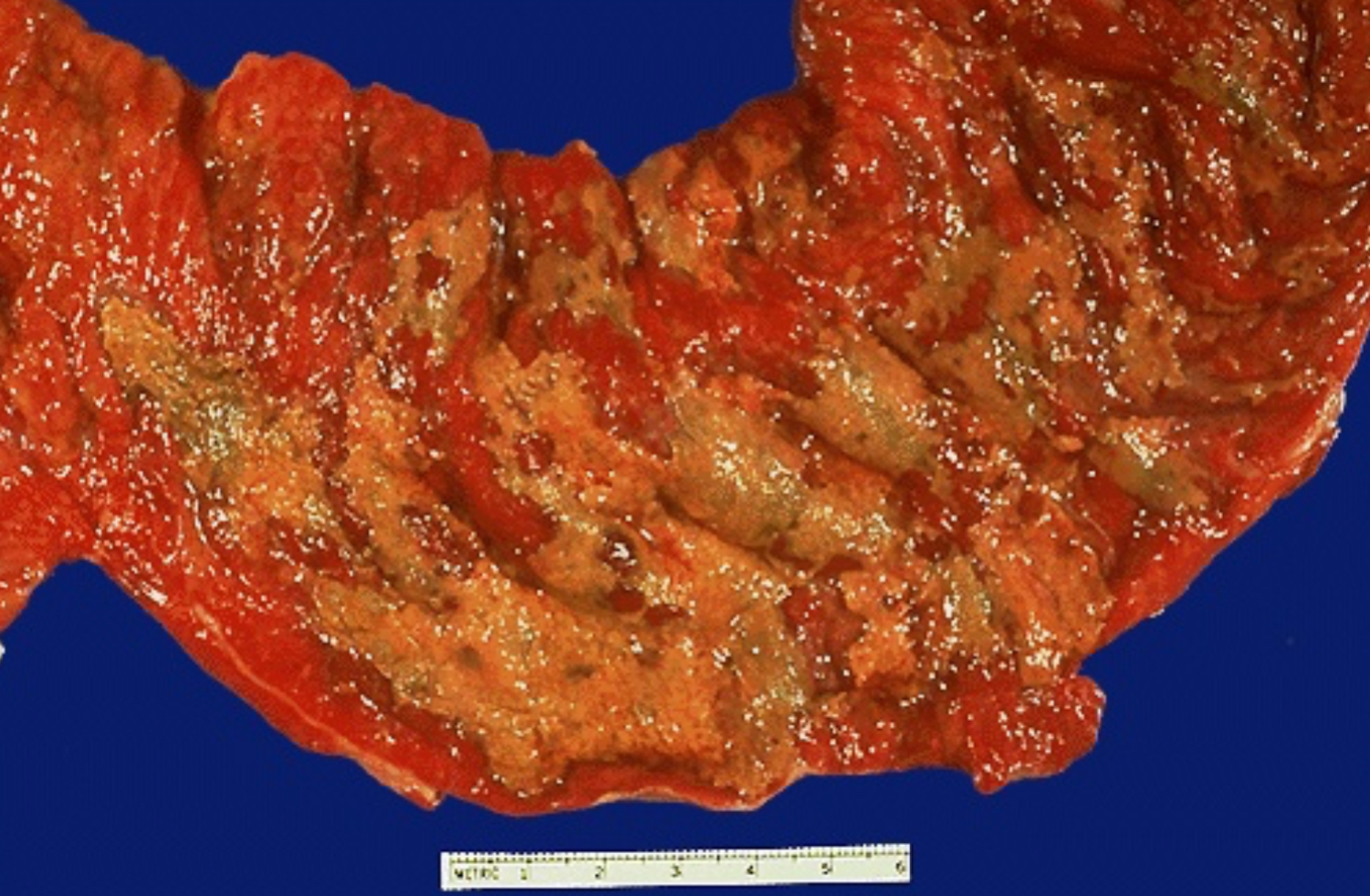 <p>Condition: inflamed, hyperemic (erythematous) bowel mucosa</p><p></p><ol><li><p>Neutrophils</p></li><li><p>Fibrin, amorphous debris of dying cells</p></li></ol><p></p>