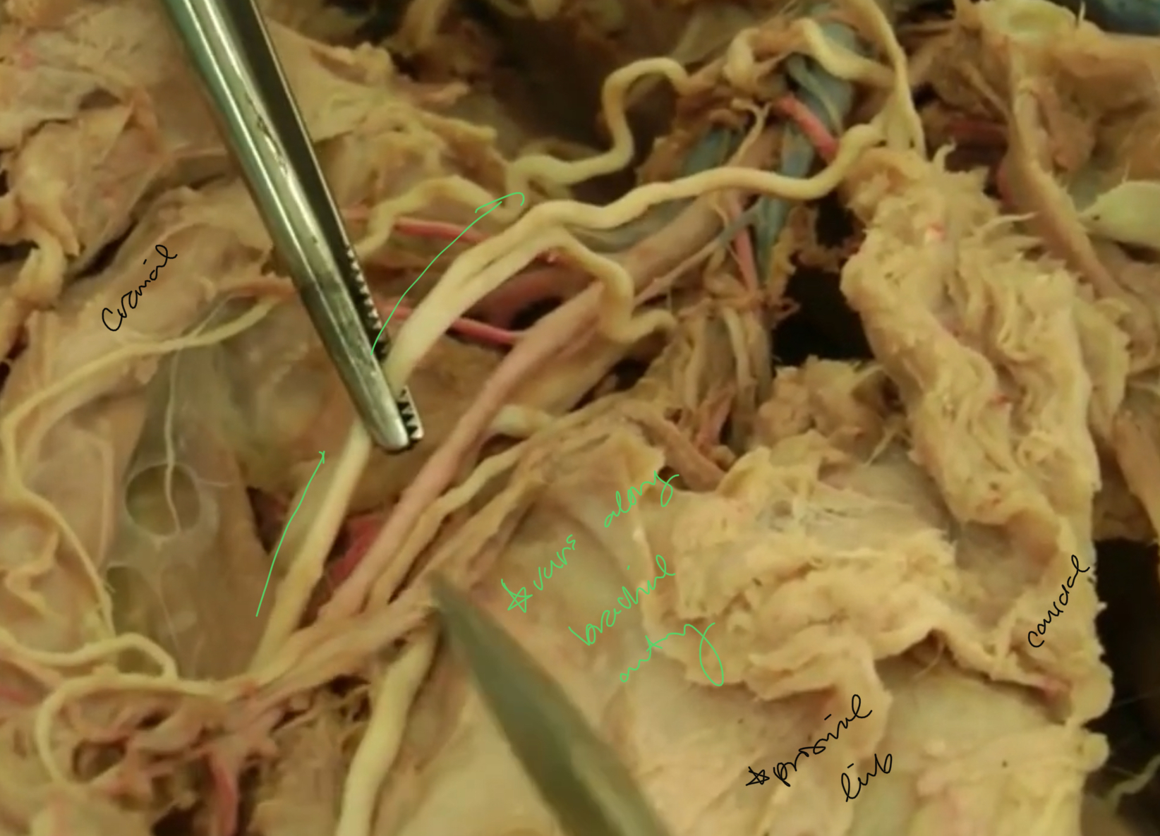 <p>What nerve is highlighted?</p>