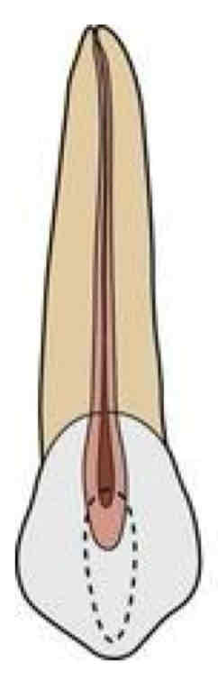 <ul><li><p>one root, one canal</p></li><li><p>has the longest root of all teeth</p></li><li><p>apical third of the root is curved towards the distal</p></li><li><p>the pulp chamber is wide labiolingually</p></li><li><p>has one pulp horn</p></li><li><p>pulp is pointed incisally</p></li><li><p>pulp space overall shape is similar to the incisor’s</p></li><li><p>root canal is usually straight but may show a distal curvature</p></li></ul>